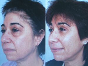before and after
