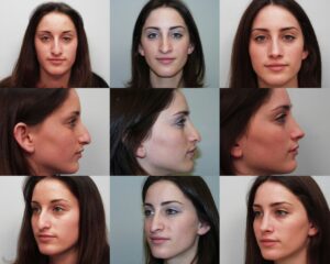 Dr. Michael A. Persky - Rhinoplasty Pre-Operative Computer Imaging Found to be Useful