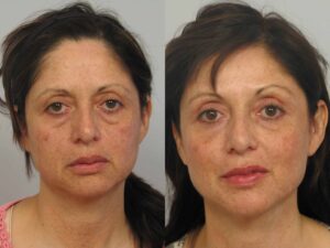 Ulthera of Face, Neck, and Eye Brows
