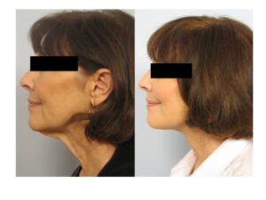 Dr. Michael A. Persky - Ultherapy (Ulthera) 2012 Update: “Doc, Will Ultherapy Work, or Do I Need a Facelift?”