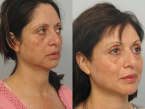 Acevedo,Clara(20110720164456973)20110902105843574 Ultherapy Before and After Results Side View