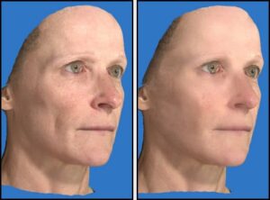 Dr. Michael A. Persky - Sculptra Rejuvenation of Temples and Eye Brows; Great Alternative to Lateral Eyebrow Lift