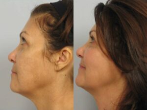 Dr. Michael A. Persky - Adding Some Life to Dull Skin…Fraxel Dual Laser Skin Rejuvenation