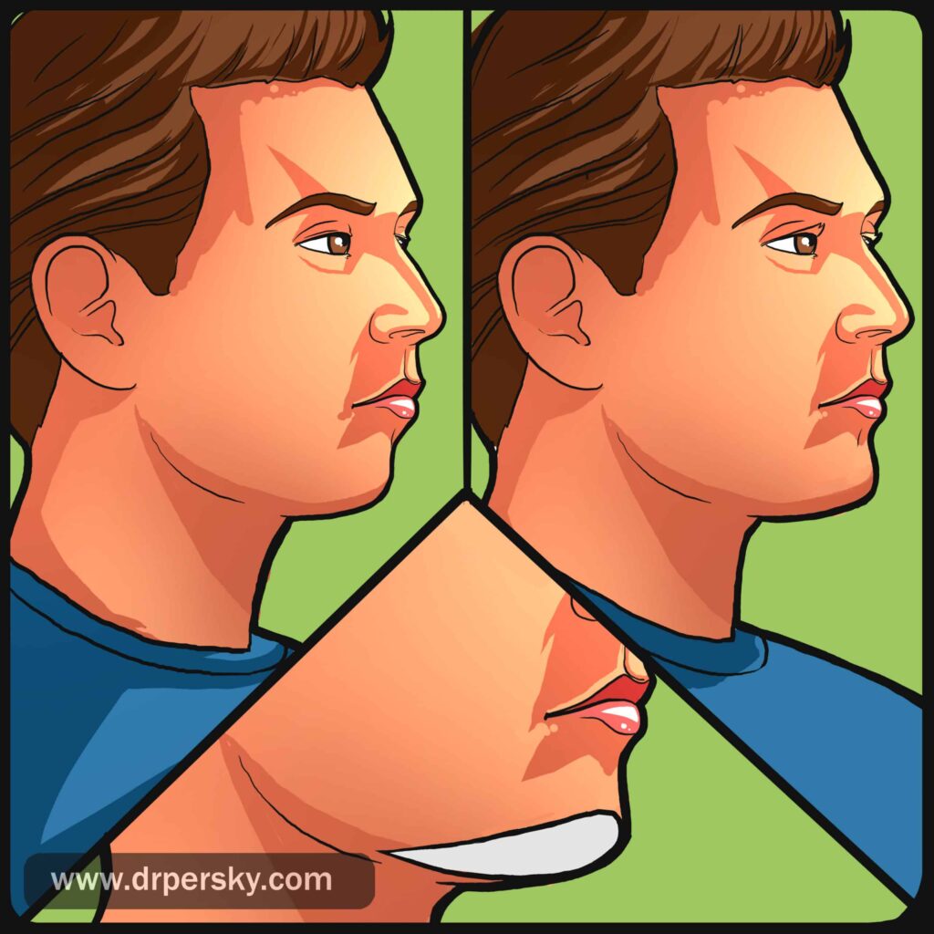 Dr. Michael A. Persky - Chin Implants Los Angeles