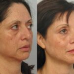 Dr. Michael A. Persky - Ulthera Need Not Be Painful…At Least at Persky Sunder Facial Plastic Surgery!!!