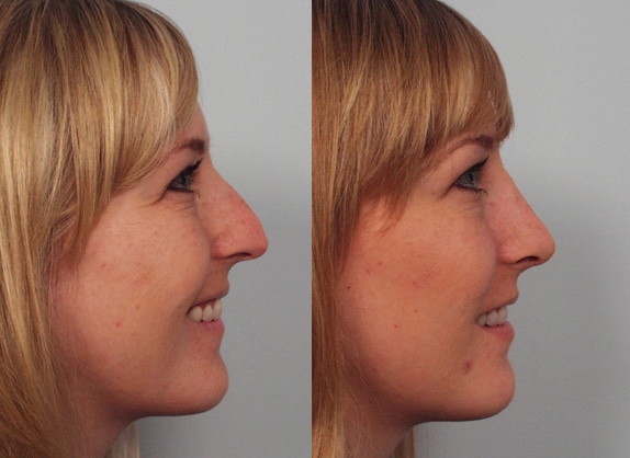 Dr. Michael A. Persky - 5 Top Reasons for Rhinoplasty (Just in Case You Are Ever on Family Feud)