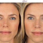 Dr. Michael A. Persky - The Allergan Facial Rejuvenation Transformation at Persky Sunder Facial Plastic Surgery