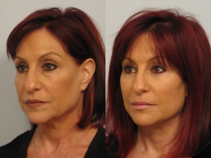 Dr. Michael A. Persky - Case Study – Lower facelift, blepharoplasty, stem cell and Necklift Beverly Hills, CA