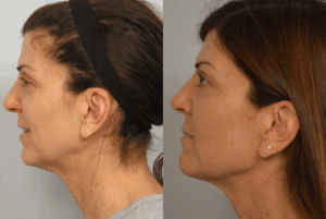 Dr. Michael A. Persky - Is Social Media Creating a Demand in Facial Procedures?