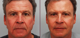Dr. Michael A. Persky - 4 Times You Should NOT Get BOTOX® Cosmetic