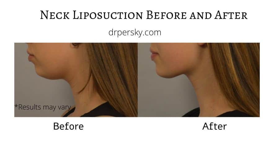 Dr. Michael A. Persky - How to Achieve Your Ideal Chin and a Defined Jawline