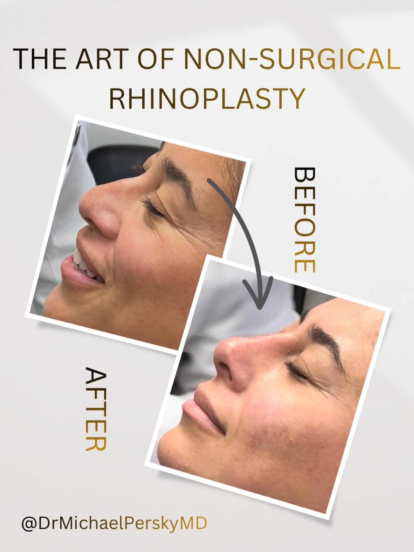 Before and After Non-Surgical Rhinoplasty