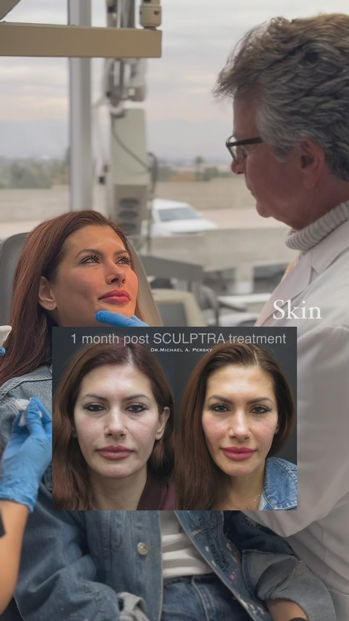 before and after sculptra