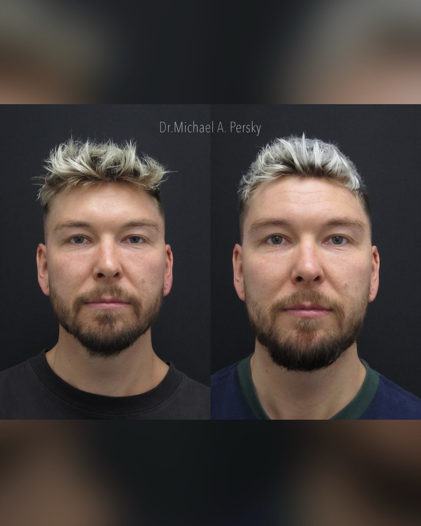 Before and after ultherapy 4