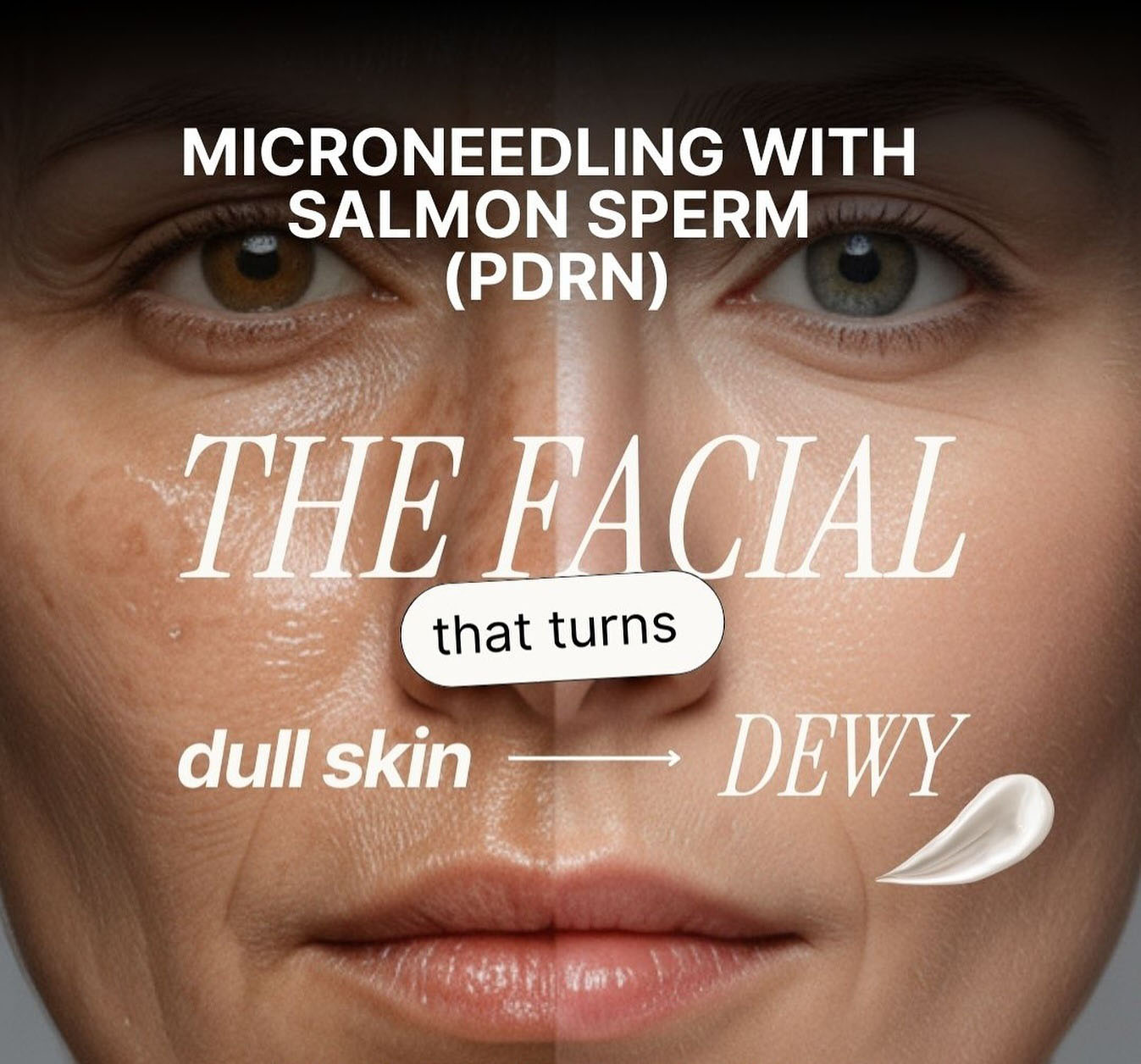 microneedling with salmon sperm, the facial that turns dull skin to dewy