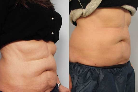 Before and After Coolsculpting in Encino California