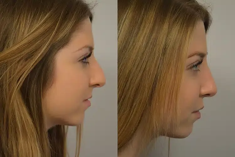 Before and After Liquid Rhinoplasty