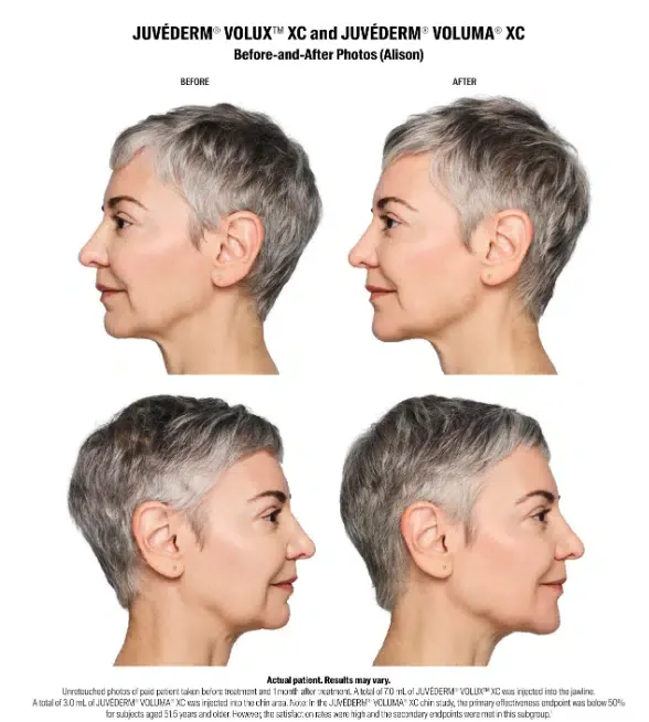 Juvederm VOLUX before and after treatment