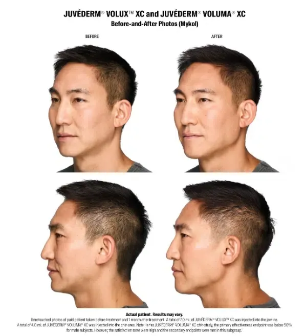 Juvederm VOLUX before and after treatment for a male patient