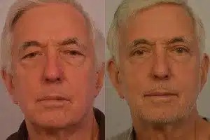 Patient Before and After Blepharoplasty - Dr. Persky