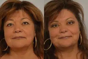 Patient Before and After Blepharoplasty - Dr. Persky