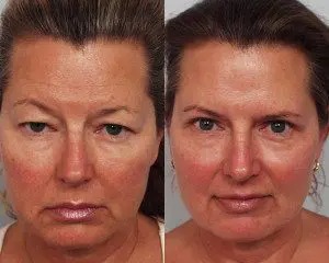 Patient Before and After Blepharoplasty - Dr. Persky