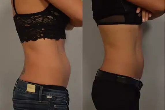 Before and After Coolsculpting in Encino CA