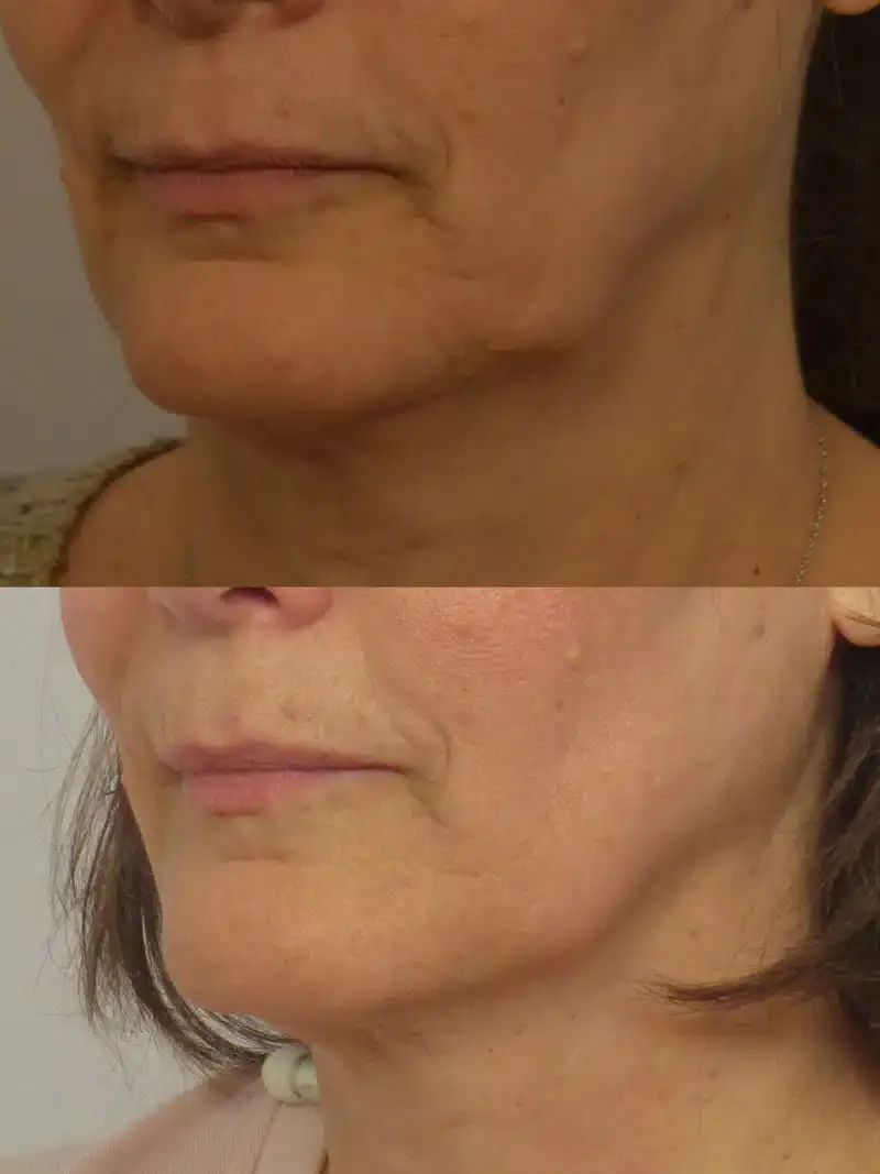 Before and after