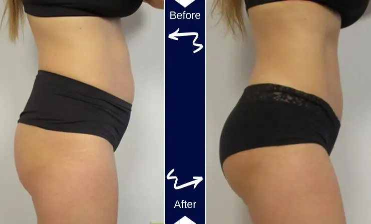 Before and After Emsculpt
