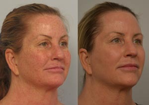 Before and after Fraxel®