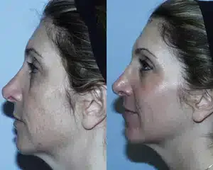 Before and after Fraxel® profile