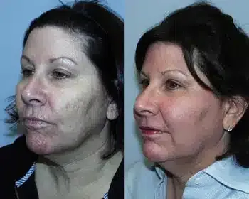 Before and after Fraxel® oblique
