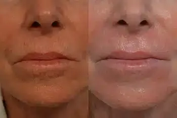 Before and after Fraxel® lips