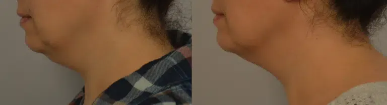 Patient before and after kybella treatment by Dr. Persky Encino CA