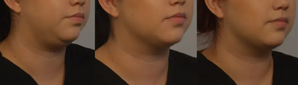 before and after kybella treatment by Dr. Persky Encino CA