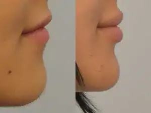 Before and After Lip Augmentation