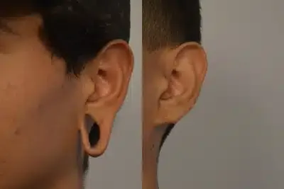 Before and after earlobe repair