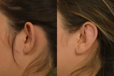 Before and after Ear Surgery