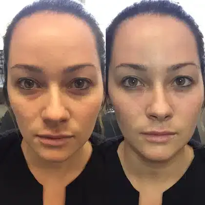 Before and after REstylane