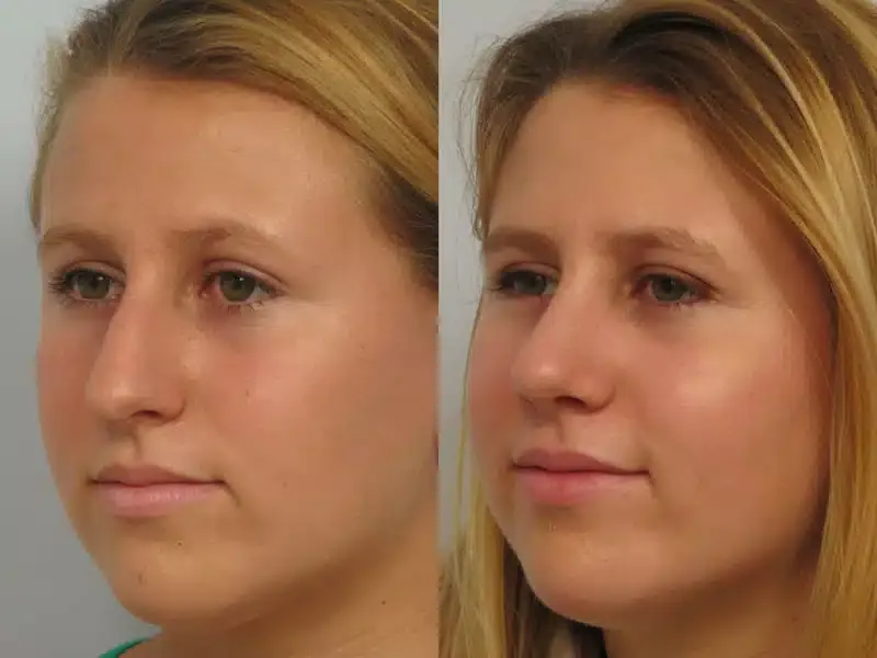Before and After Liquid Rhinoplasty / Non-Surgical Rhinoplasty