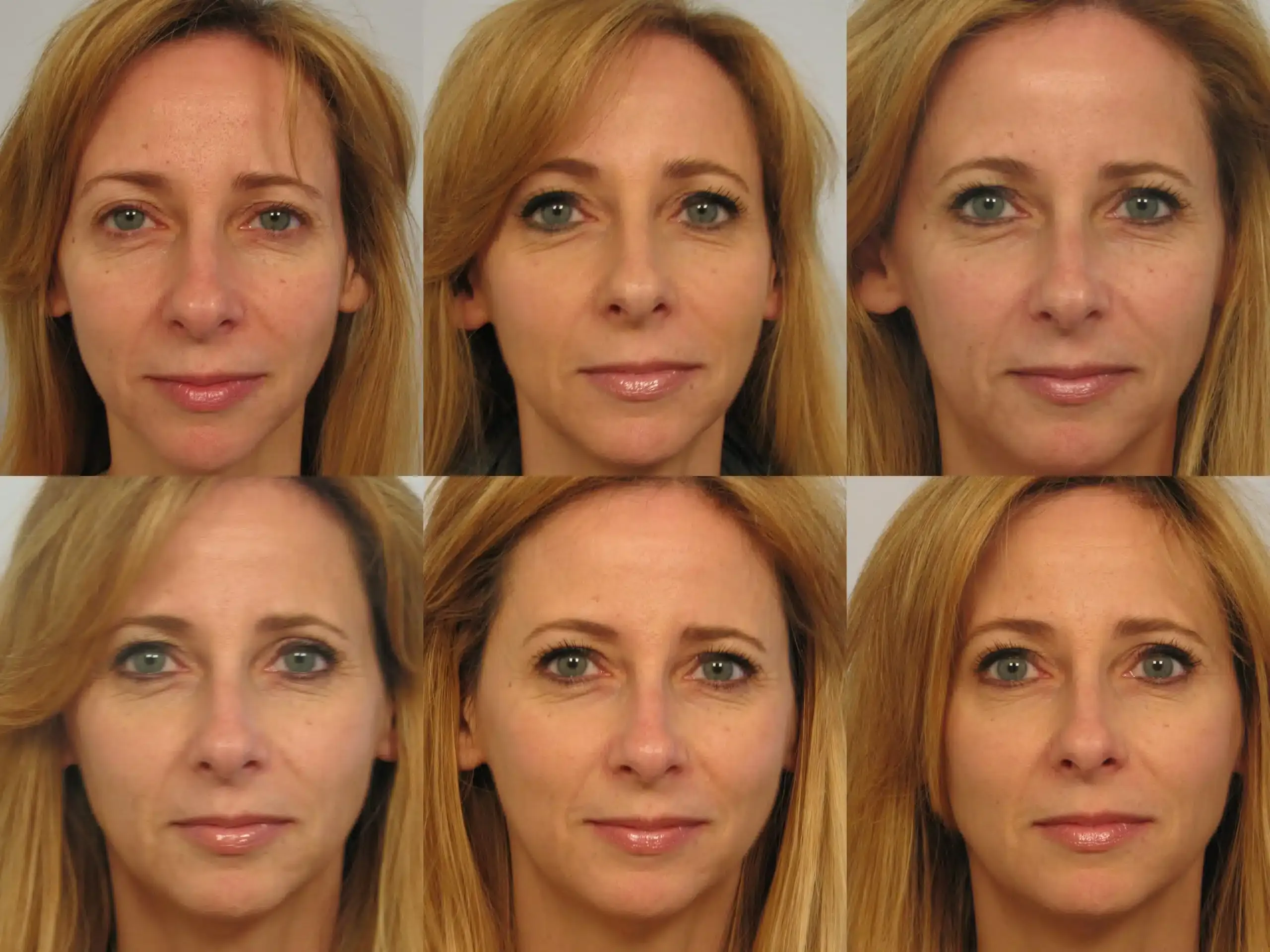 before and after Sculptra® treatment 1