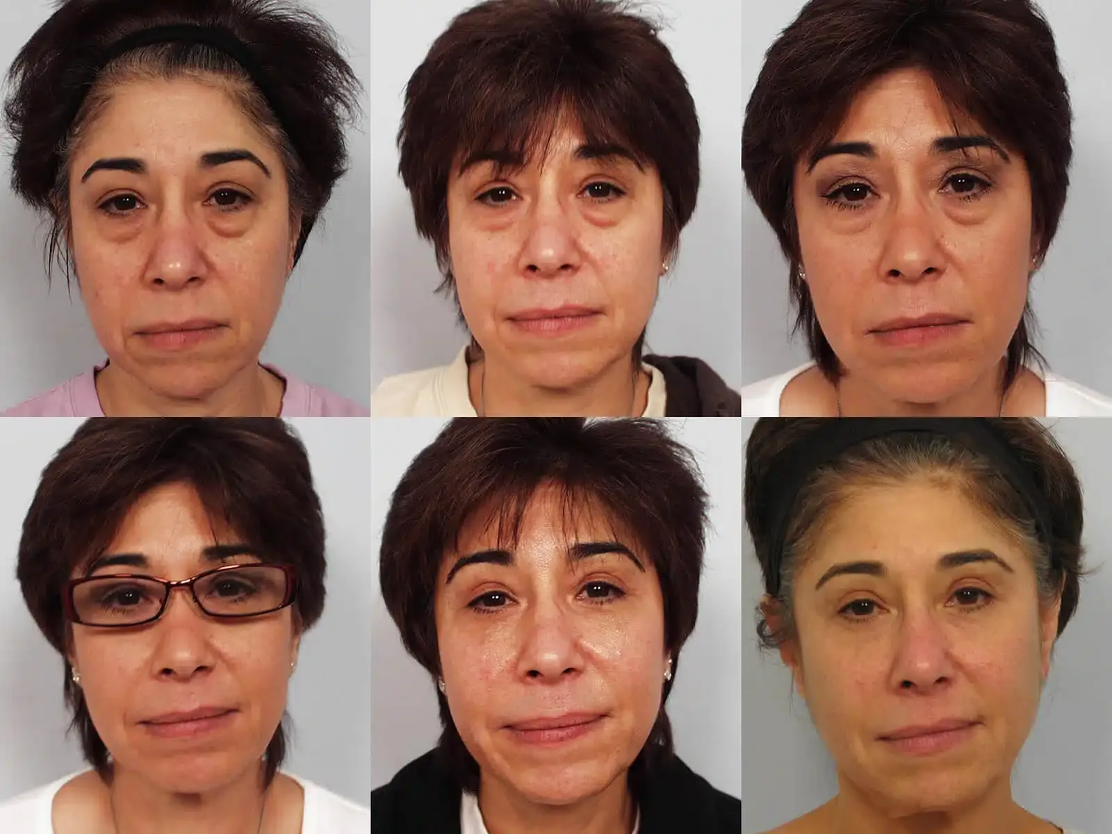 before and after Sculptra® treatment 3