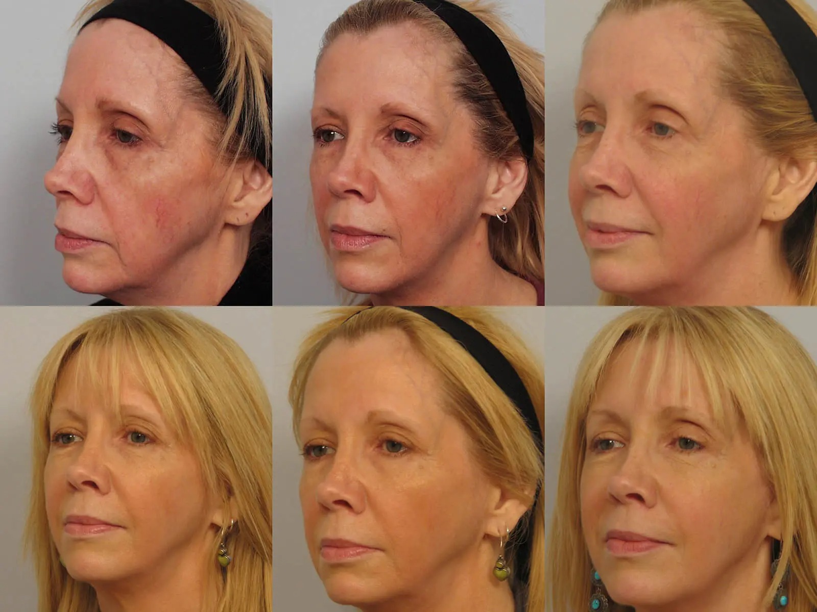 before and after Sculptra® treatment in profile