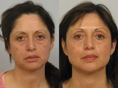 Before and after ultherapy 3