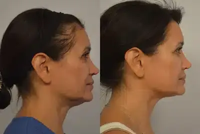 Before and after ultherapy 2