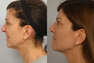 Before and after ultherapy 1