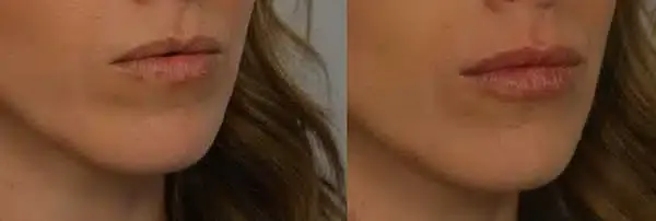 Before and After Lip Augmentation with lip fillers