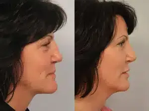 Before and after Injectable Filler JUVÉDERM VOLUMA® XC