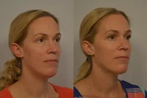 Before and after Injectable Filler