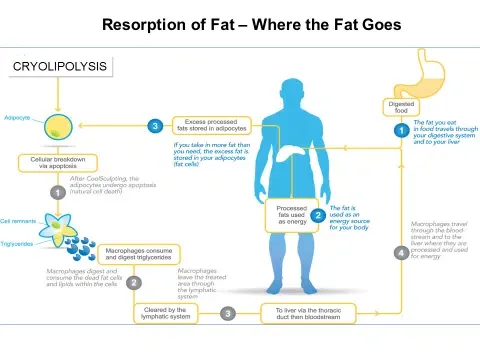 Coolsculpting: Resorption of Fat – Where the Fat Goes